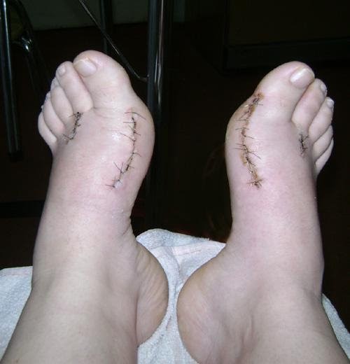 Os Pés: 20 dias depois da cirurgia