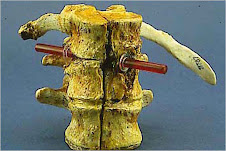 Garfield's First Lumbar Vertebra