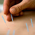 Acupuntura!