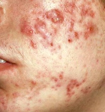 Doce em um acne