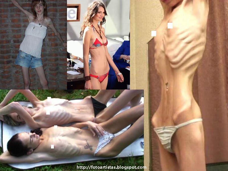 Xxx Porn Sex Anorexia Bulimia Skinny Brunette Posing 4