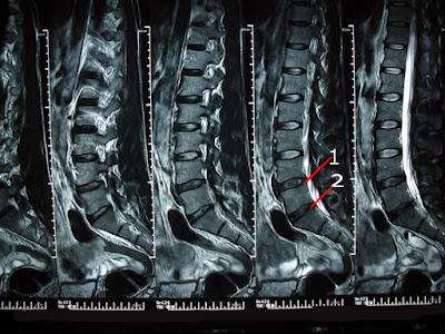 Dessicated Disc