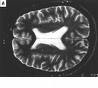 [encephalopathy.jpg]
