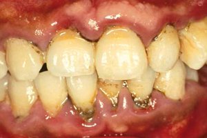 [sm_gum_disease.jpg]