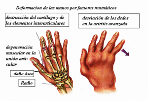 Como curar sheynyy la osteocondrosis a las mujeres