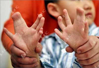 Unbelievable - Chinese Boy With 34 Fingers