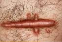 Cicatrizacion+queloide