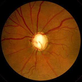 [glaucoma3.jpg]