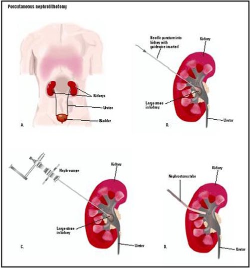 why oh why if im pissy blame my kidney stones size of kidney stones