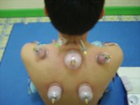 Cupping pada titik HIjamah (Bekam)