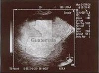 My Guat sonogram!