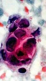 [breast_cancer_cells.jpg]