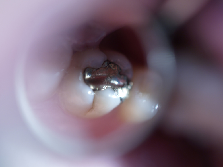 Dental materials ADA WHO releases report on dental materials, amalgam