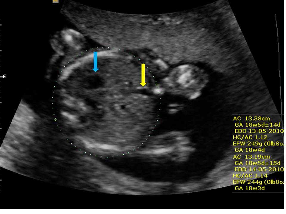 Abdominal Circumference