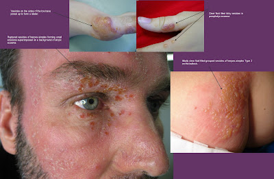 valtrex for oral herpes valtrex for oral herpes