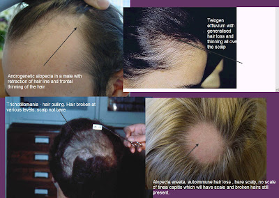 is hair loss a side effect of methotrexate