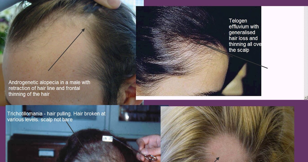 Differential Diagnosis In Dermatology Hair Problems