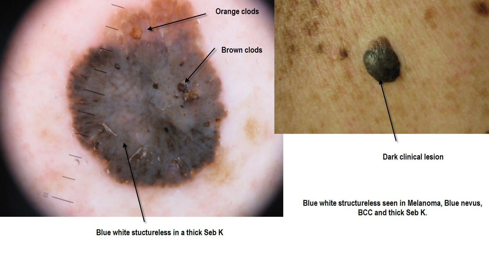 seborrheic keratosis vs melanoma