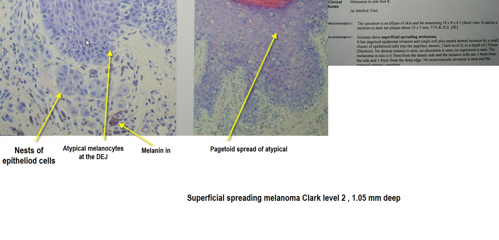 Acral Melanoma Pictures