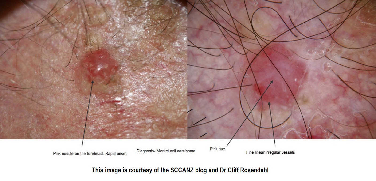 Clear Cell Acanthoma