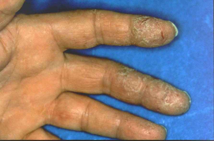 [hand+dermatitits.jpg]