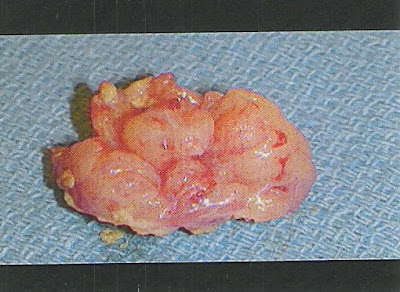 healing tonsils