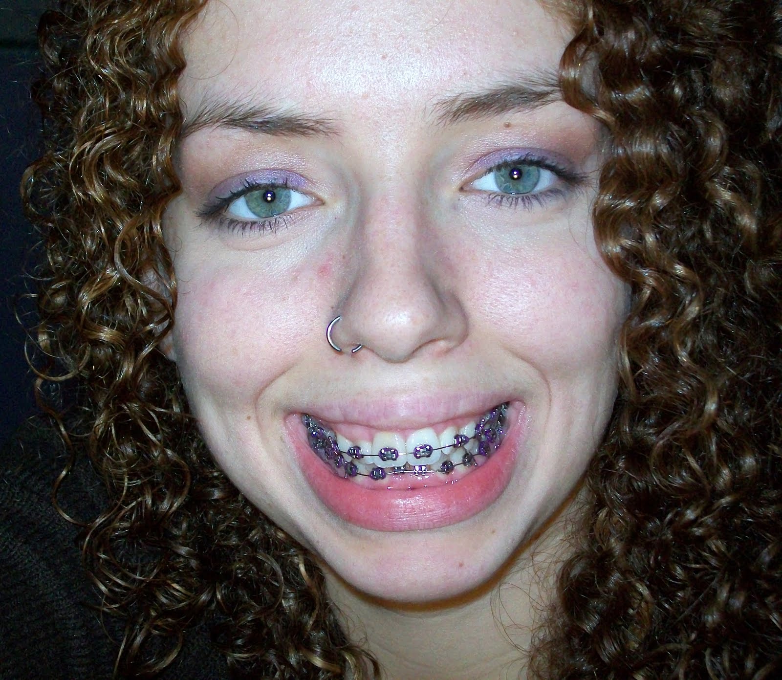 Braces At Twenty My First Braces Tightening