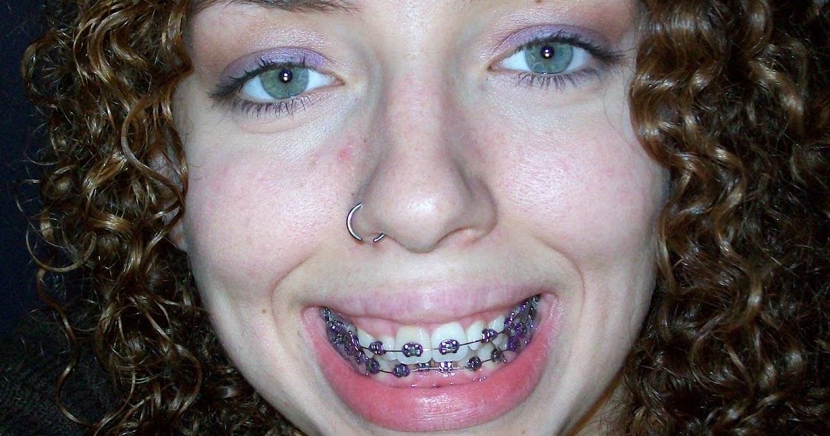 Braces at twenty My First Braces Tightening