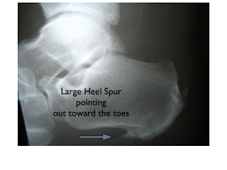 Calcaneal Spur