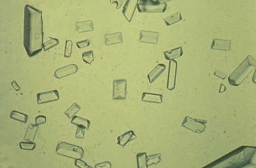 These cystine crystals are amorphous urate crystals in urine. These cystine crystals are