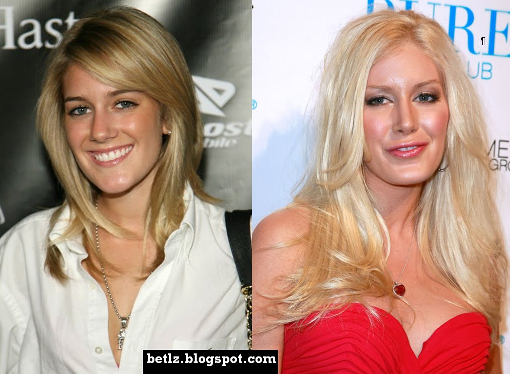 heidi montag before and after 10 plastic surgery. heidi montag before and after