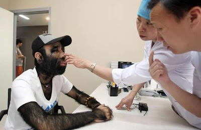 Hairiest Chinese Man Decides to Remove his Hair