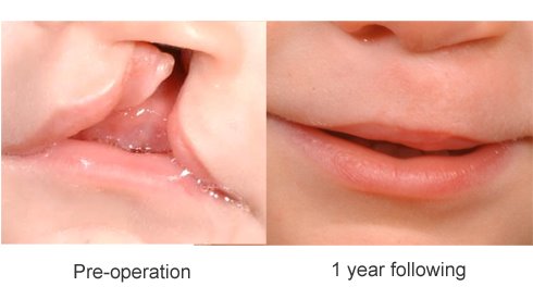 Cleft Lip and Palate Surgery: Before and After