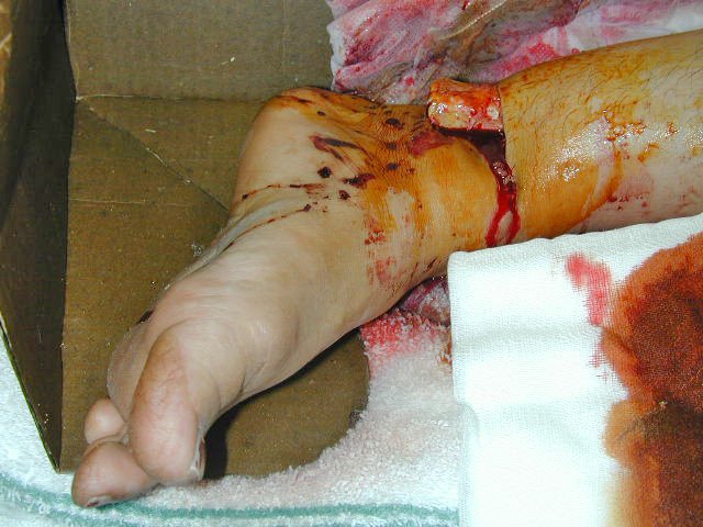 [Compound_fracture_dislocation_left_ankle.jpg]