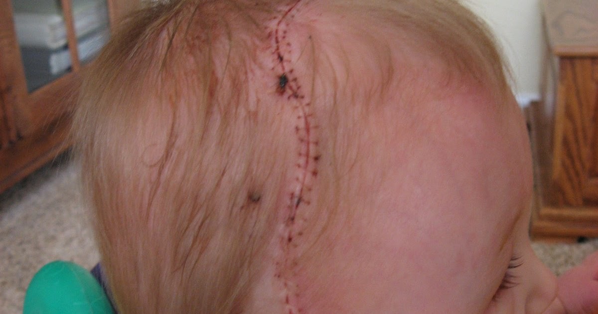 coronal craniosynostosis incision