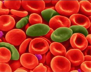 Sickle cell disease is an