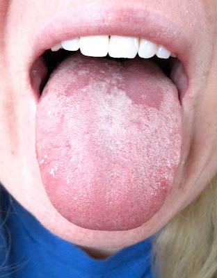 White Patch On Tounge