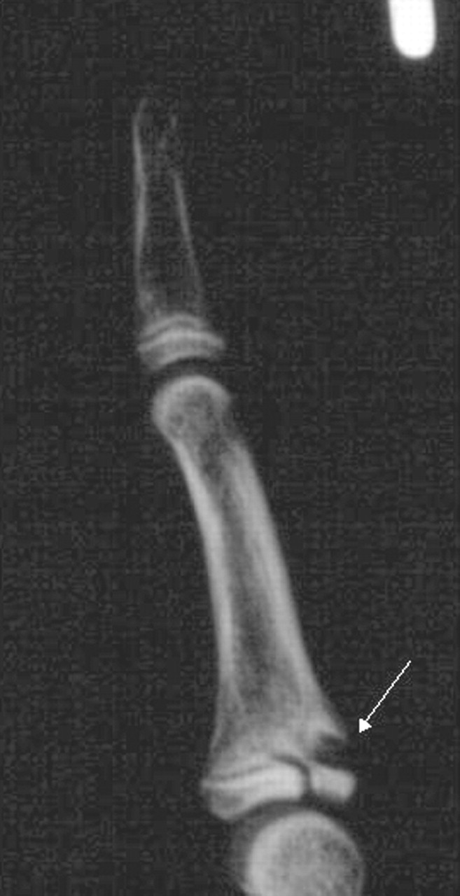 Compund Fracture Epiphyseal Fracture seperates from diaphysis along epipyseal line-4.bp.blogspot.com