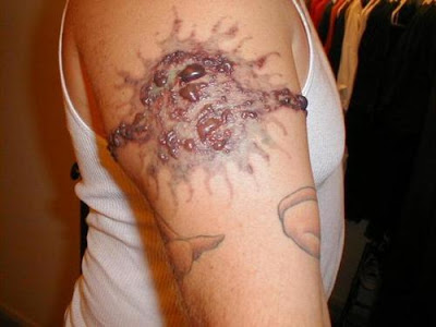 Excision Tattoo Removal - The Safest Method of Removing Your Tattoo?