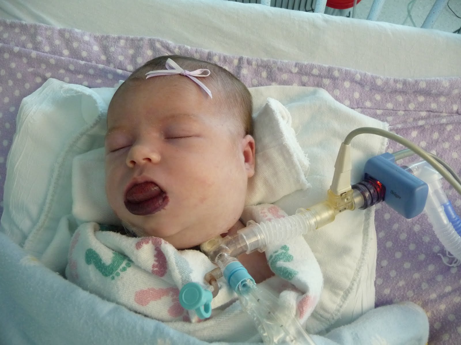 Trach Ties July 2010