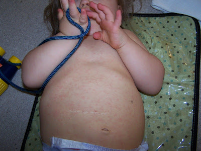 Viral Rash