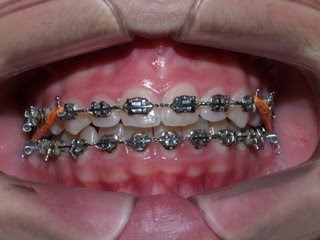 dientes dientes