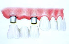 Puente cementado sobre dos Implantes