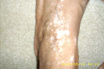 Feet with pigment loss