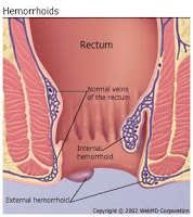 Cure Hemorrhoids