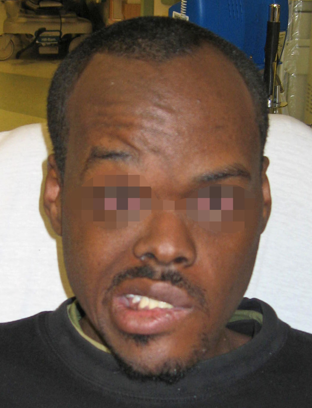 Acute Herpetic Pharyngitis
