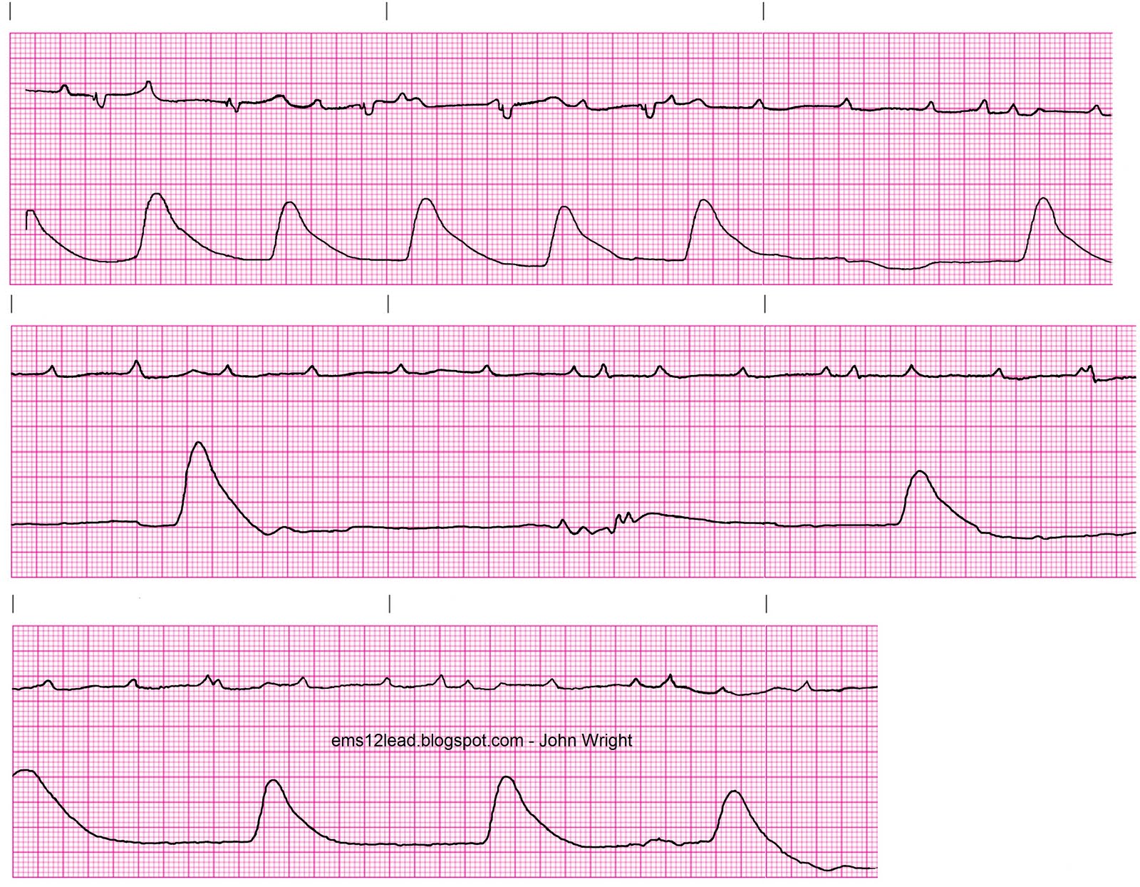 Picture of a man orgasm Ekg with rhythm strip