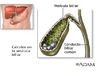 [colelitiasis.bmp]
