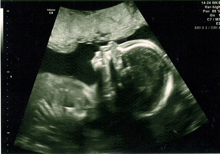 van BASTELAAR, etc. 20 week ultrasound