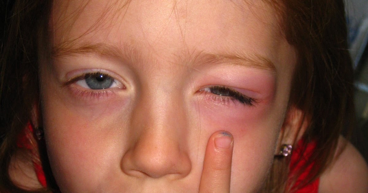 P.S. I love you the most Black Eye or Mosquito Bite?